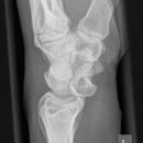 Lunatumluxation