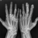 Calcinosis cutis