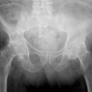 Coxarthrose