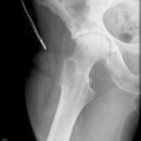 Coxarthrose