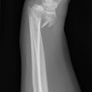 distale Radius-Ulnafraktur mit Palmarabkippung