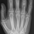 Enchondrom mit pathologischer Fraktur