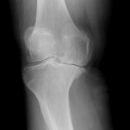 Gonarthrose