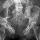 Open Book Fracture