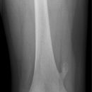 Osteochondrom