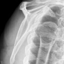 Schulterluxation