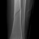 Spiralfraktur Tibia
