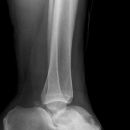 Totale Talusluxation