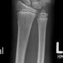 Wulstfraktur distler Radius